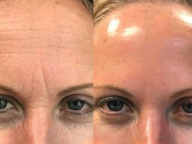 microneedling-skin-tightening-2-kireth-ai