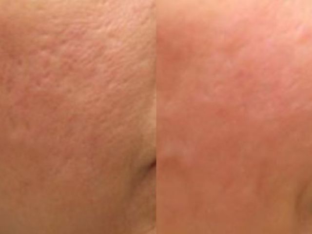 microneedling-skin-tightening-4-kireth-ai