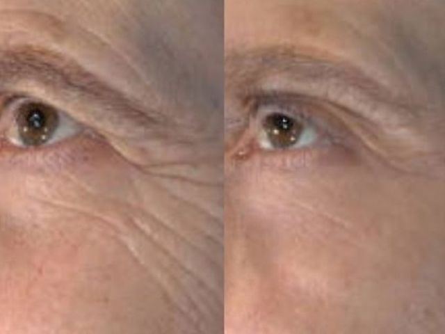 microneedling-skin-tightening-5-kireth-ai