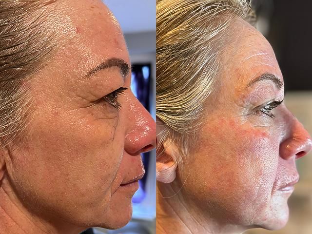 non-surgical-facelift-8-kireth-ai