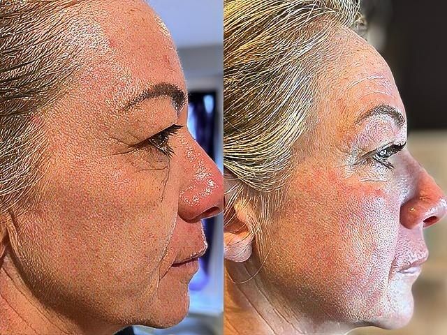 non-surgical-facelift-8-kireth-ai-kireth-ai