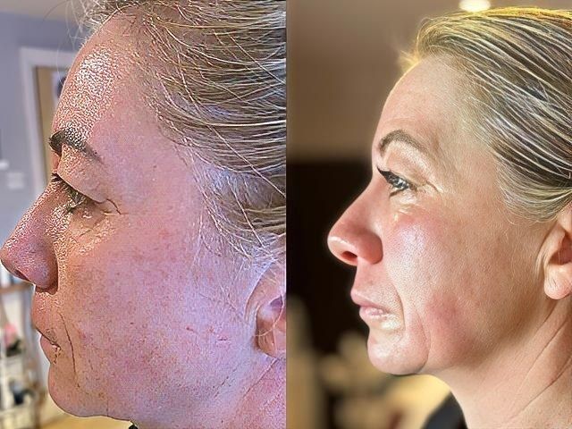 non-surgical-facelift-9-kireth-ai-kireth-ai