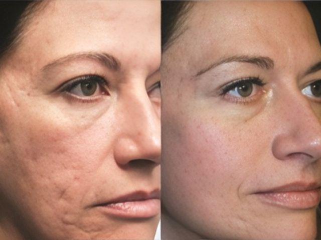 microneedling-skin-tightening-6-kireth-ai