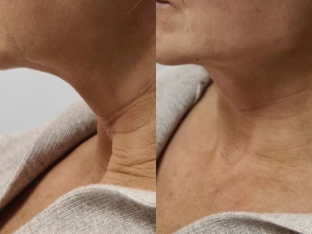 microneedling-skin-tightening-7-kireth-ai