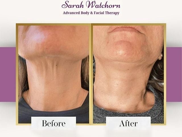 before-after-6-kireth-ai