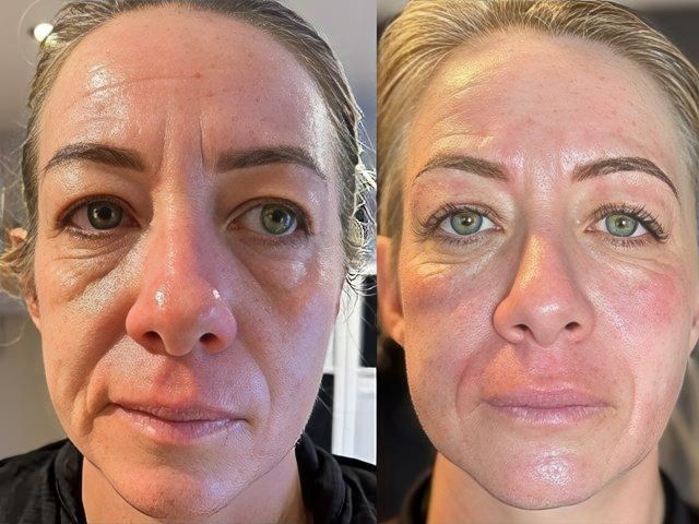 non-surgical-facelift-6-kireth-ai-kireth-ai