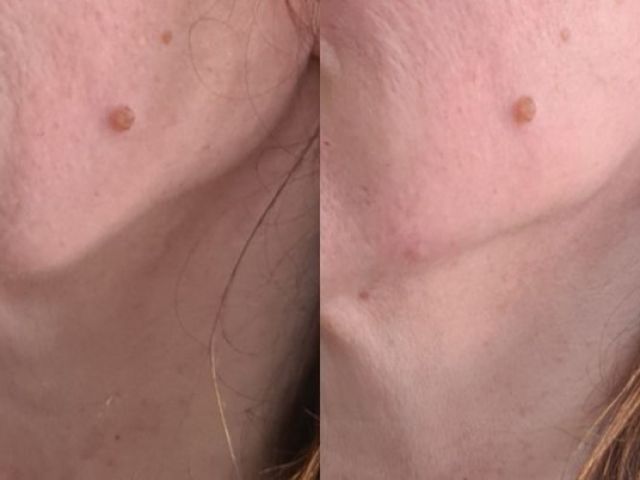 microneedling-skin-tightening-9-kireth-ai