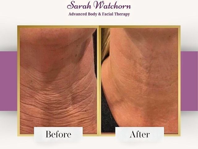 before-after-11-kireth-ai
