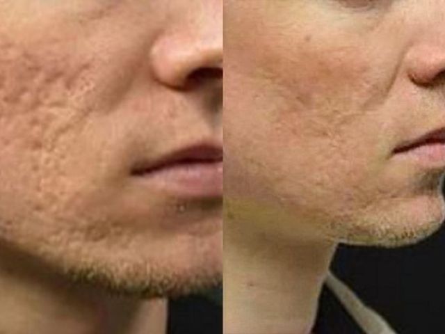 microneedling-skin-tightening-8-kireth-ai