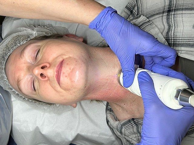 microneedling-skin-tightening-1-kireth-ai