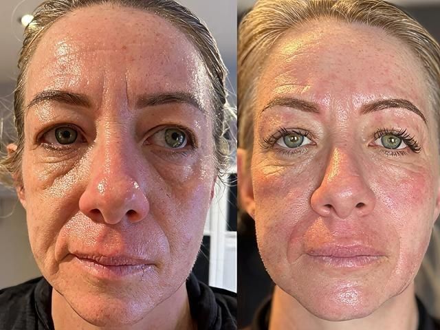 non-surgical-facelift-6-kireth-ai