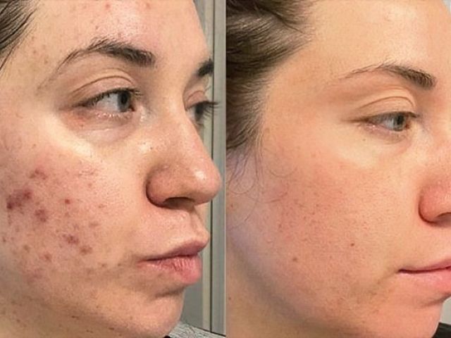 microneedling-skin-tightening-3-kireth-ai