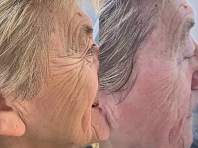 non-surgical-facelift-7-kireth-ai-kireth-ai