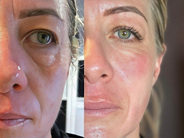 non-surgical-facelift-5-kireth-ai-kireth-ai