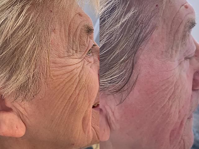 non-surgical-facelift-7-kireth-ai