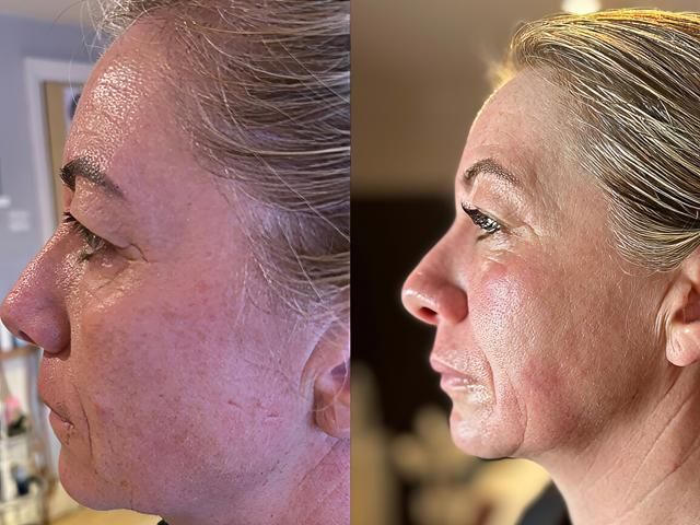 non-surgical-facelift-9-kireth-ai