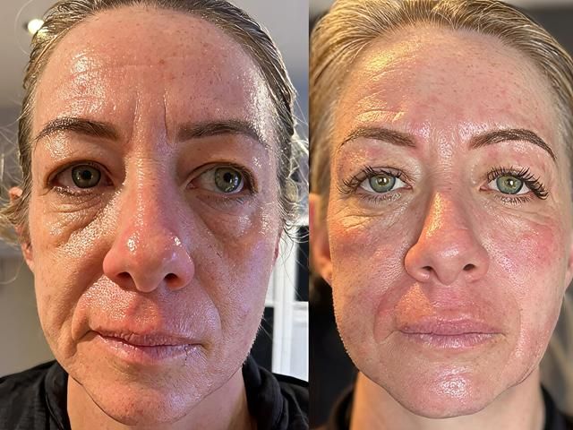 non-surgical-facelift-6-kireth-ai